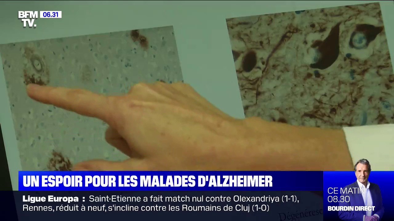 Alzheimer: pour la première fois, un laboratoire américain réussit à faire reculer la maladie et ses symptômes