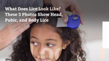 What Does Lice Look Like? These 3 Photos Show Head, Pubic, and Body Lice