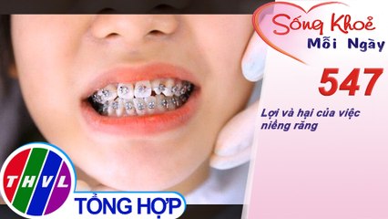 Lợi và hại của việc niềng răng | Sống khỏe mỗi ngày - Kỳ 547