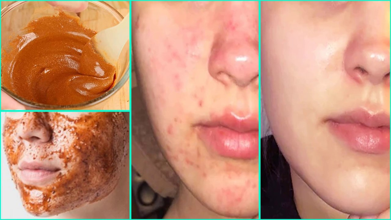 The Complete Guide Of Use Honey And Cinnamon For Acne
