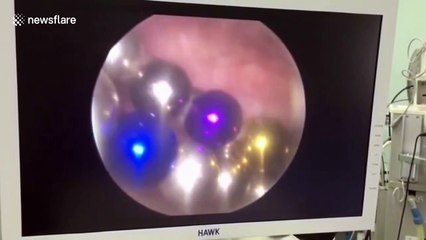 Chinese doctor removes 28 magnetic balls from man's urinary bladder