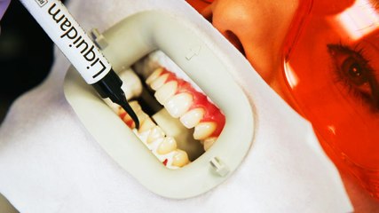 The fastest way to whiten teeth