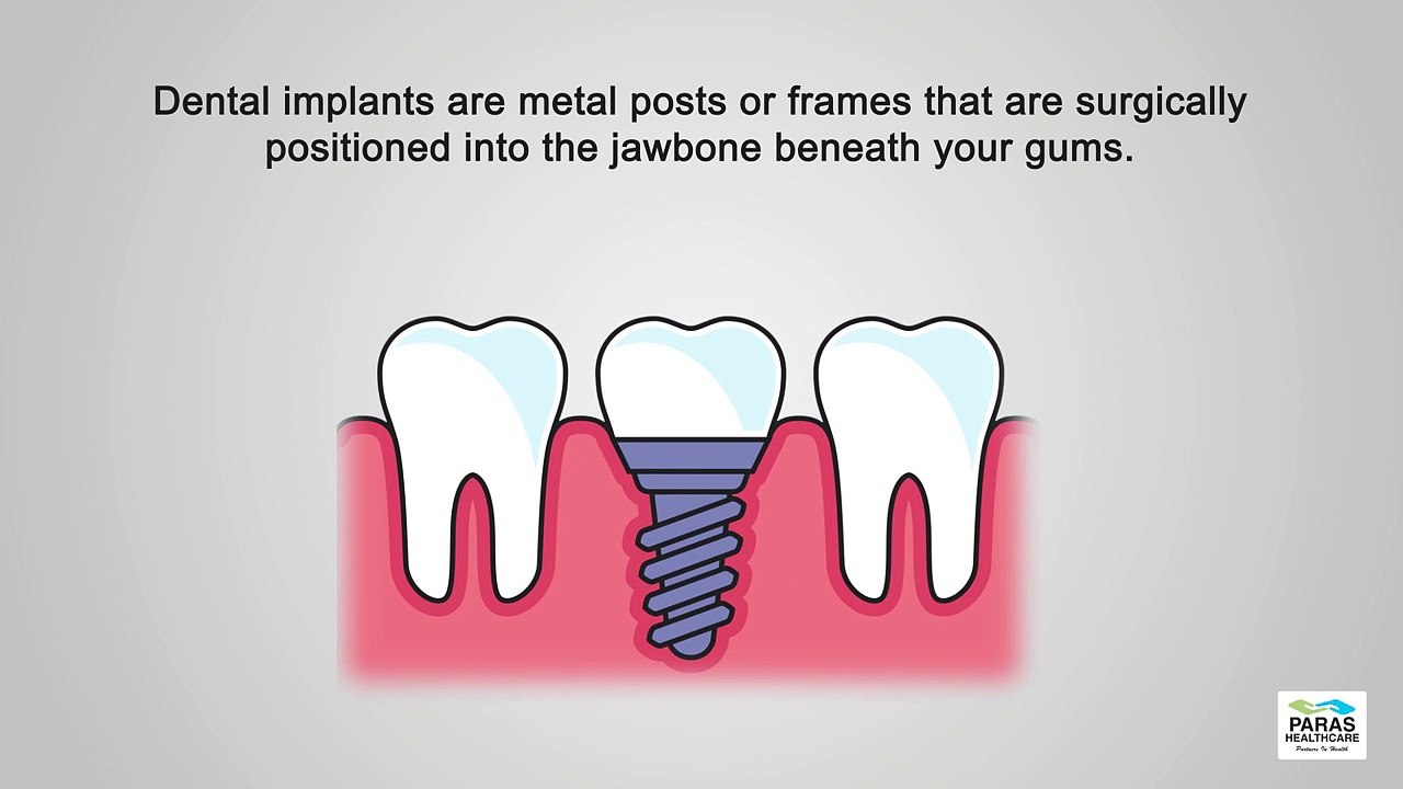 Dental Implants | Paras Hospitals