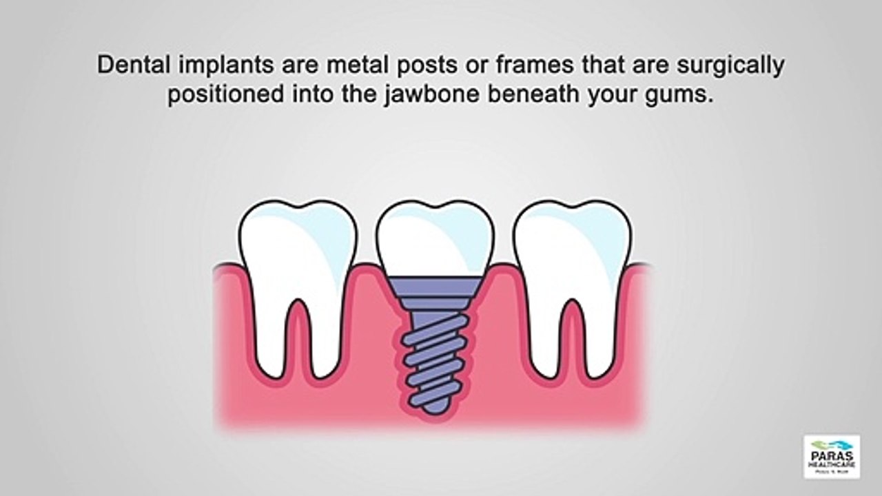 Dental Implants | Paras Hospitals