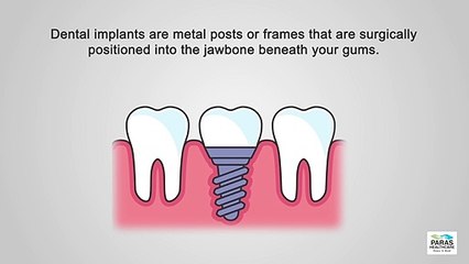 Dental Implants | Paras Hospitals