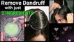 Magical Home Remedy to Remove DANDRUFF at home Dandruff treatment How to get rid of dandruff
