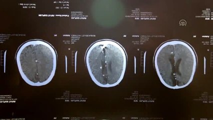 Kahraman gazi 28 yıldır başındaki 14 şarapnel parçasıyla yaşıyor