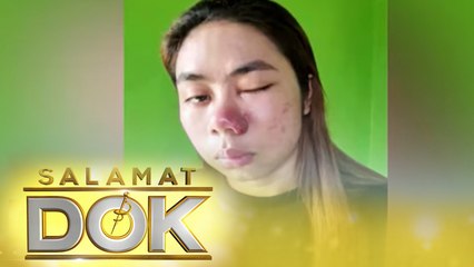 Glaiza Borromeo shares her struggles when she had a serious acne problem | Salamat Dok