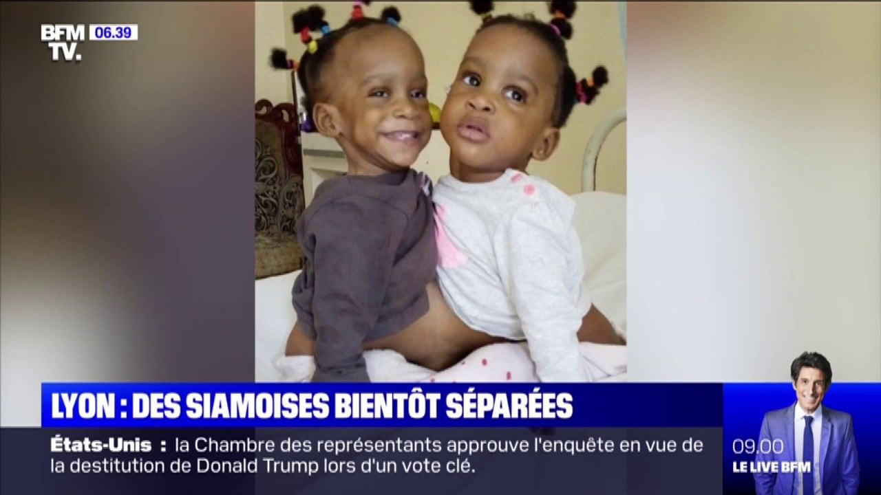 Deux sœurs siamoises d'un an seront séparées le 7 novembre prochain à Lyon