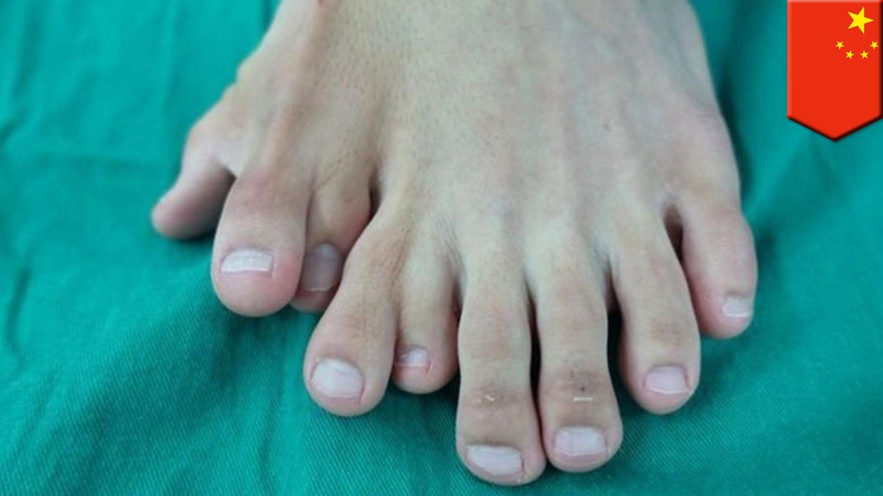 Man with 9 toes on left foot has surgery to remove freeloaders