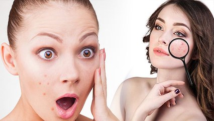 पिंपल्स को दूर करेगी डार्क चॉकलेट | Pimple free skin | get rid of pimples with dark chocolate