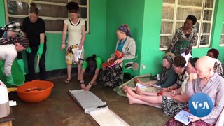 Women With Albinism Struggle to Find Work