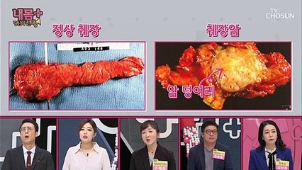 생존률 10% 미만↓ 증상이 없어 더 무서운 췌장암