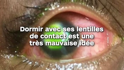 Dormir avec ses lentilles de contact est une très mauvaise idée, la preuve en images !