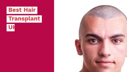 Best Hair Transplant Clinic in UK - Revive Hair & Skin Clinic