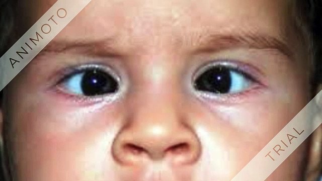 Cataract surgeon in Indore | lasik Eye surgery in Indore