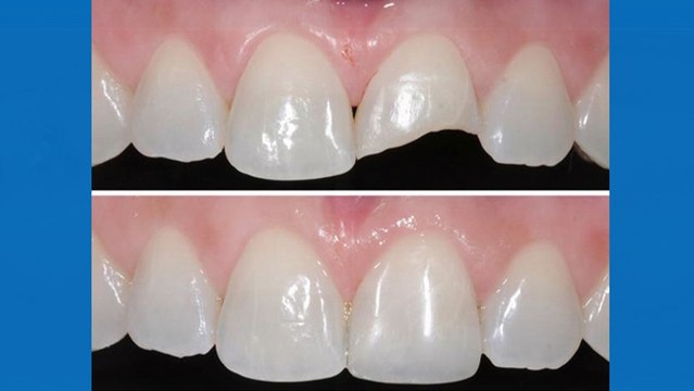 bd-tipos-de-calzas-y-cual-es-la-mejor-opcion-061119