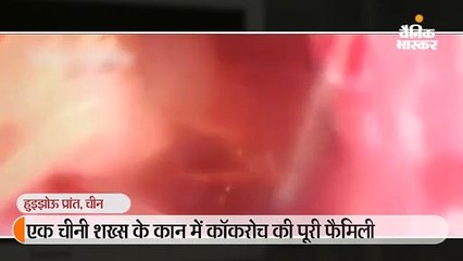24 साल के युवक ने कान में कुछ चलने की शिकायत की, जांच में 10 कॉकरोच निकले