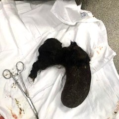 10 yıl boyunca yediği saçları midesinden çıkarıldı