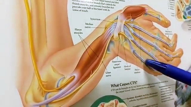 Manhid ang Kamay Libreng Gamutan sa Carpal Tunnel Syndrome - ni Doc Willie Ong