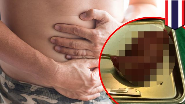 泰國六旬老翁多年腹痛 膽囊內積滿超過800顆「珍珠」