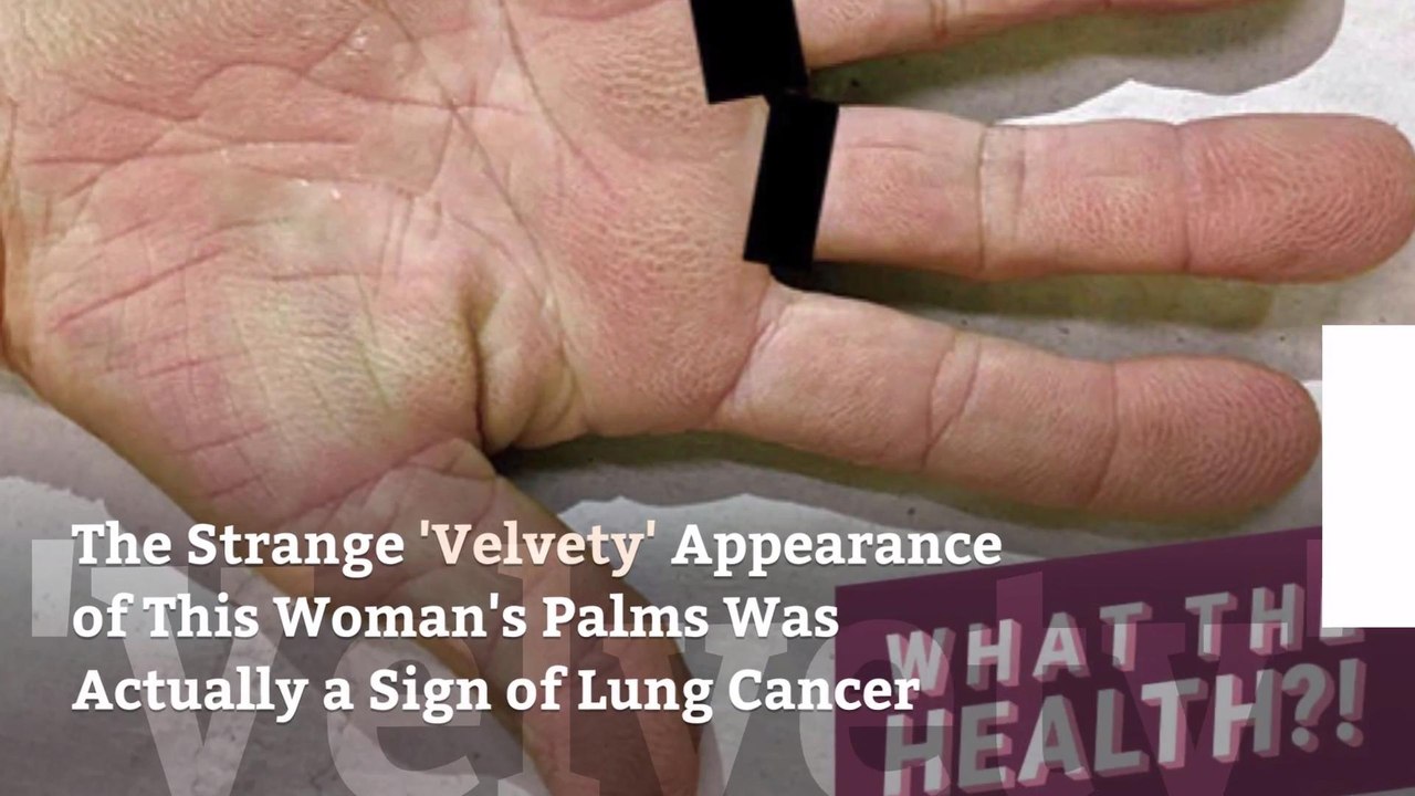 The Strange 'Velvety' Appearance of This Woman's Palms Was Actually a Sign of Lung Cancer