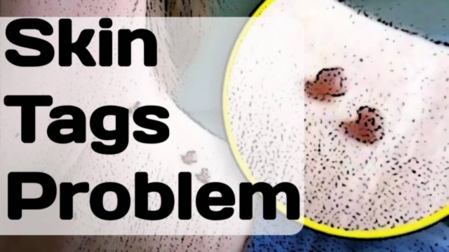 How to Remove Skin Tags Naturally Painlessly At Home