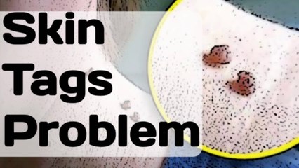 How to Remove Skin Tags Naturally Painlessly At Home