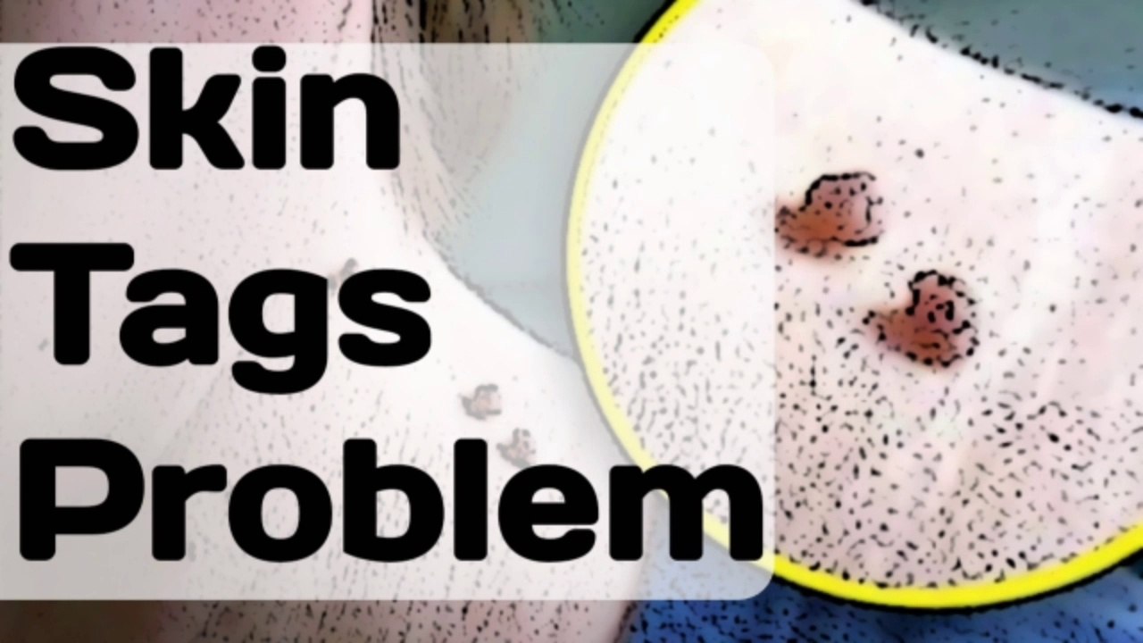 How to Remove Skin Tags Naturally Painlessly At Home