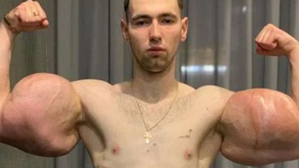 Russian bodybuilder with 24-inch oil-injected Popeye biceps has surgery to save arms