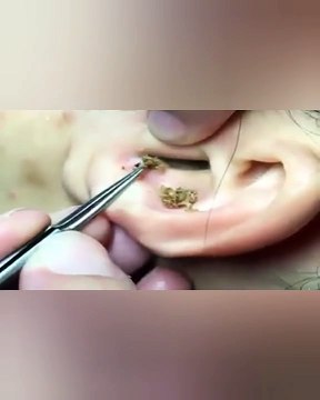Blackheads On Ear