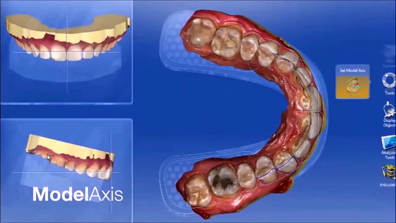 Wanna know how Dental Veneers in Korea work? | Seoul Guide Medical