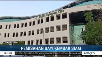 Bayi Kembar Siam Ardi dan Ardan Berhasil Dipisahkan