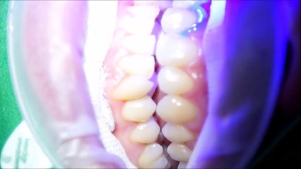 How to get a your teeth white through a laser? Check this for more!