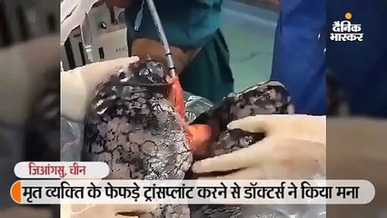 व्यक्ति ने 30 साल रोजाना सिगरेट पी, दोनों फेफड़े काले पड़े; ट्रांसप्लांट नहीं हो सके