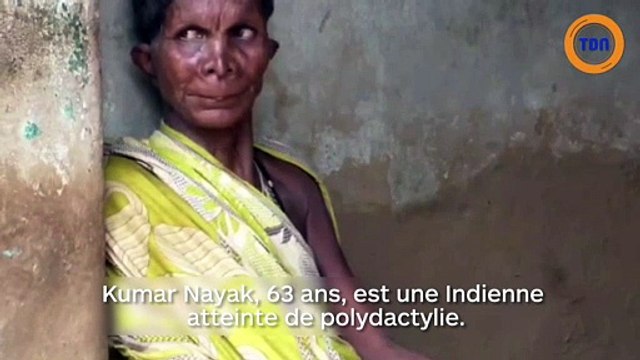 12 doigts et 20 orteils : ses voisins ont peur d'elle