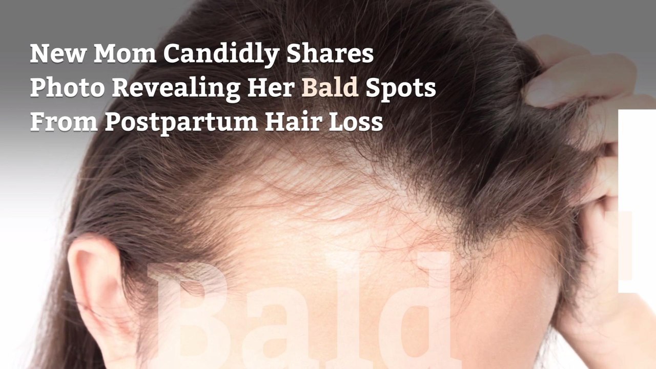 New Mom Candidly Shares Photo Revealing Her Bald Spots From Postpartum Hair Loss