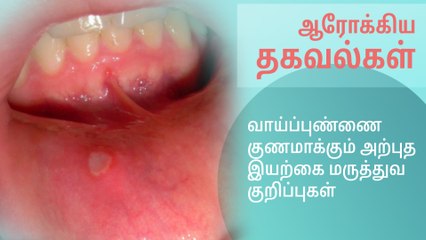 வாய்ப்புண்ணை குணமாக்கும் அற்புத இயற்கை மருத்துவ குறிப்புகள்..!