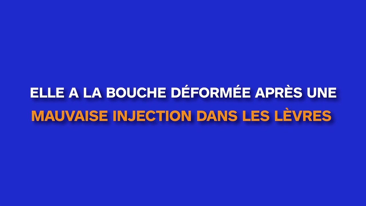 Une adolescente se retrouve avec une bouche déformée après une injection désastreuse dans les lèvres