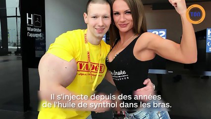 Le Popeye russe s'est fait opérer des bras pour enlever ses biceps monstrueux