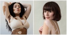 Une séance photo en « ode à la beauté et à l'unicité » du vitiligo prise par une photographe elle-même atteinte