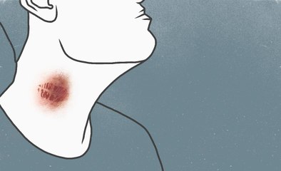 How to Get Rid of a Hickey—or At Least Cover It Up