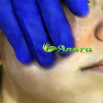 Vampire Facial New Jersey is a rejuvenation of your skin