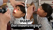 เปิดคลิปสยอง หมอเอาทากออกจากจมูกเด็ก ดื่มน้ำในลำธาร ระวังเจอแบบนี้ !!
