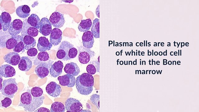 Cord Blood can cure Cancer Cells caused by Multiple Myeloma