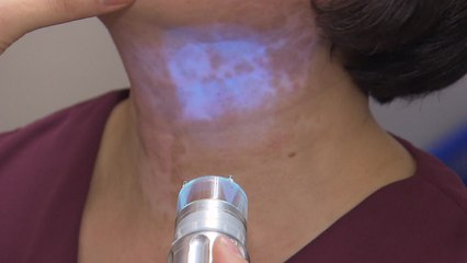 피부질환 '백반증' 절반 가량 "우울감·사회생활 지장" / YTN