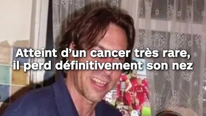 Atteint d’un cancer très rare, il perd définitivement son nez