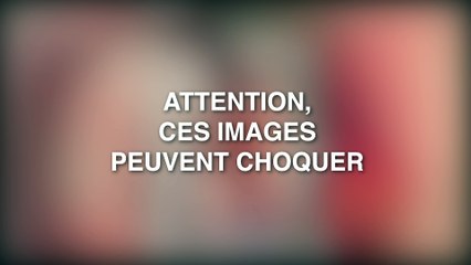 Santé : Les médecins redonnent la vie à un cœur mort !