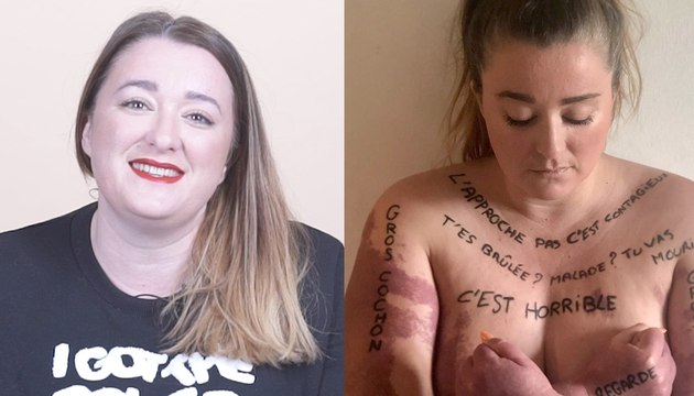 Victime de cyberharcèlement parce qu'elle dévoile son corps | Le Speech de Julie, la fille qui a des taches