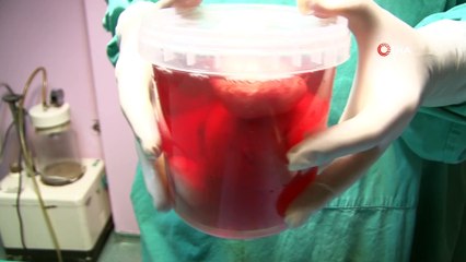 26 yaşındaki bir kızın karnından 15 santimlik miyom çıktı